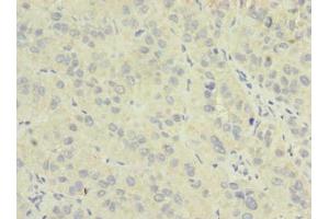 Immunohistochemistry of paraffin-embedded human liver cancer using ABIN7162044 at dilution of 1:100 (NME7 anticorps  (AA 1-150))
