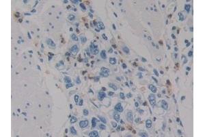 Detection of HIF1aN in Human Stomach cancer Tissue using Polyclonal Antibody to Hypoxia Inducible Factor 1 Alpha Subunit Inhibitor (HIF1aN)