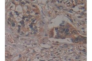 Detection of GCLM in Human Pancreatic cancer Tissue using Polyclonal Antibody to Glutamate Cysteine Ligase, Modifier Subunit (GCLM) (GCLM anticorps  (AA 40-251))