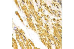 Immunohistochemistry of paraffin-embedded human gastric cancer using CYP2E1 antibody at dilution of 1:100 (x400 lens). (CYP2E1 anticorps)