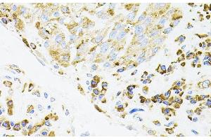 Immunohistochemistry of paraffin-embedded Human lung cancer using IRF1 Polyclonal Antibody (IRF1 anticorps)