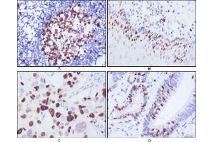 Immunohistochemical analysis of paraffin-embedded human lymph node (A), esophagus (B), lung cancer (C), rectum cancer (D), showing nuclear localization using KI67 antibody with DAB staining. (Ki-67 anticorps)