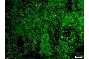 Formalin-fixed and paraffin embedded human rectal carcinoma tissue labeled with Rabbit Anti-GPR30 Polyclonal Antibody (ABIN685717) at 1:200 followed by conjugation to the secondary antibody and DAB staining