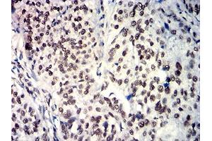 Immunohistochemical analysis of paraffin-embedded bladder cancer tissues using SOX11 mouse mAb with DAB staining.