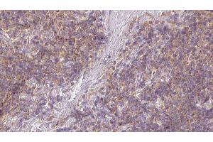 ABIN6273173 at 1/100 staining Human lymph cancer tissue by IHC-P. (SDC3 anticorps)