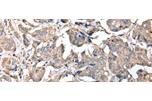 Immunohistochemistry of paraffin-embedded Human breast cancer tissue using KCTD16 Polyclonal Antibody at dilution of 1:25(x200) (KCTD16 anticorps)
