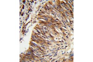 Formalin-fixed and paraffin-embedded human lung carcinoma reacted with ALDH3B1 Antibody (Center), which was peroxidase-conjugated to the secondary antibody, followed by DAB staining. (ALDH3B1 anticorps  (AA 334-360))