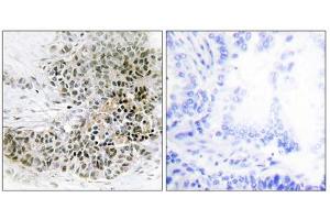 Immunohistochemistry analysis of paraffin-embedded human lung carcinoma tissue, using TRPS1 antibody. (TRPS1 anticorps  (N-Term))