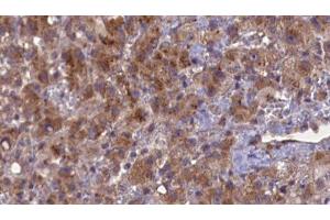 ABIN6276934 at 1/100 staining Human liver cancer tissue by IHC-P. (GABRB2 anticorps  (N-Term))