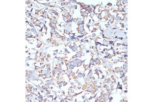 Immunohistochemistry of paraffin-embedded human breast cancer using COX5A antibody (ABIN6130953, ABIN6138912, ABIN6138913 and ABIN6222082) at dilution of 1:100 (40x lens).