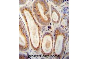 WFDC12 antibody (C-term) immunohistochemistry analysis in formalin fixed and paraffin embedded human prostate carcinoma followed by peroxidase conjugation of the secondary antibody and DAB staining.