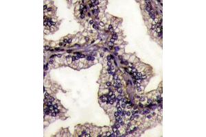 Formalin-fixed and paraffin-embedded prostata carcinoma tissue reacted with LTF Antibody (Center) (ABIN1882099 and ABIN2841775) , which was peroxidase-conjugated to the secondary antibody, followed by DAB staining.