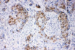 Anti-beta Arrestin 1 antibody, IHC(P) IHC(P): Human Mammary Cancer Tissue (beta Arrestin 1 anticorps  (N-Term))