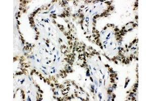 Anti-HDAC3 antibody,  IHC(P) IHC(P): Human Lung Cancer Tissue
