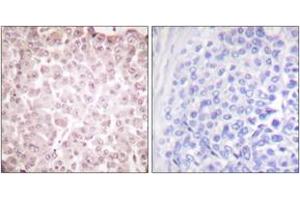 Immunohistochemistry analysis of paraffin-embedded human breast carcinoma tissue, using RCBTB1 Antibody. (RCBTB1 anticorps  (AA 251-300))