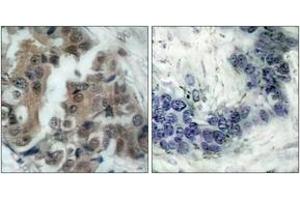 Immunohistochemistry analysis of paraffin-embedded human breast carcinoma, using BAD (Phospho-Ser136) Antibody. (BAD anticorps  (pSer99))