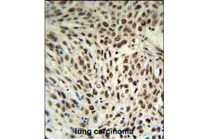 SNRPD3 Antibody IHC analysis in formalin fixed and paraffin embedded human lung carcinoma followed by peroxidase conjugation of the secondary antibody and DAB staining.