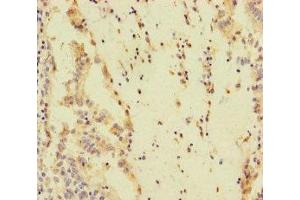 Immunohistochemistry of paraffin-embedded human lung cancer using ABIN7170492 at dilution of 1:100 (SPEM1 anticorps  (AA 50-309))