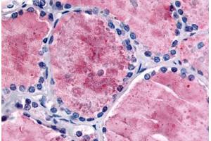 Human Thyroid (formalin-fixed, paraffin-embedded) stained with PDE8B antibody ABIN213536 at 5 ug/ml followed by biotinylated goat anti-rabbit IgG secondary antibody ABIN481713, alkaline phosphatase-streptavidin and chromogen. (PDE8B anticorps  (Internal Region))