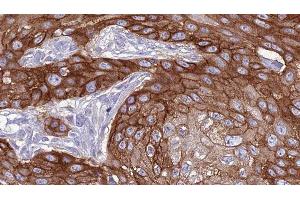 ABIN6277379 at 1/100 staining Human Head and neck cancer tissue by IHC-P.
