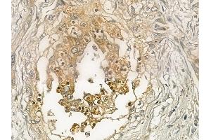 ABIN6262025 and ABIN6272961 at 1/100 staining human cervical carcinoma by IHC-P. (GNMT anticorps  (Internal Region))