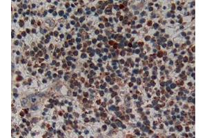 IHC-P analysis of Human Skin cancer Tissue, with DAB staining. (CRH anticorps  (AA 40-195))