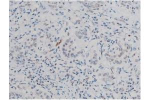 ABIN6267389 at 1/200 staining Human ganstric cancer tissue sections by IHC-P.