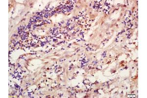 Formalin-fixed and paraffin embedded human lung carcinoma labeled with Anti-TRIB3 Polyclonal Antibody, Unconjugated (ABIN872793) at 1:200 followed by conjugation to the secondary antibody and DAB staining (TRIB3 anticorps  (AA 201-300))