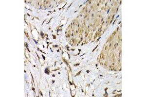 Immunohistochemistry of paraffin-embedded human gastric cancer using ISG15 Antibody. (ISG15 anticorps)