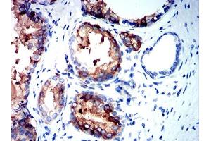 Immunohistochemical analysis of paraffin-embedded prostate cancer tissues using NEFH mouse mAb with DAB staining. (NEFH anticorps  (AA 2-251))