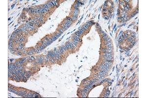 Immunohistochemical staining of paraffin-embedded Adenocarcinoma of Human colon tissue using anti-KHK mouse monoclonal antibody. (Ketohexokinase anticorps)