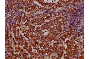 IHC image of ABIN7145214 diluted at 1:100 and staining in paraffin-embedded human lung cancer performed on a Leica BondTM system. (BAG3 anticorps  (AA 220-420))