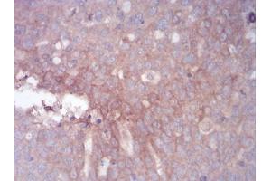 Immunohistochemistry (IHC) image for anti-Zinc Finger Protein GLI1 (GLI1) (AA 284-449) antibody (ABIN5866847) (GLI1 anticorps  (AA 284-449))