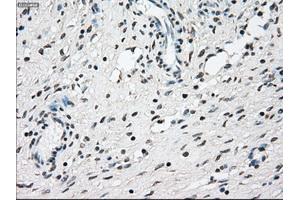 Immunohistochemical staining of paraffin-embedded Adenocarcinoma of breast tissue using anti-NRBP1 mouse monoclonal antibody. (NRBP1 anticorps)