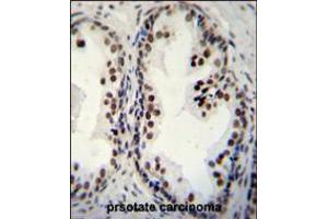 DDX27 Antibody immunohistochemistry analysis in formalin fixed and paraffin embedded human prsotate carcinoma followed by peroxidase conjugation of the secondary antibody and DAB staining.