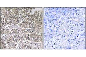 Immunohistochemistry analysis of paraffin-embedded human liver carcinoma tissue, using SLC25A21 Antibody. (SLC25A21 anticorps  (AA 134-183))