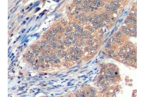 Detection of ICOSLG in Human Endometrial cancer Tissue using Polyclonal Antibody to Inducible T-Cell Co Stimulator Ligand (ICOSLG)