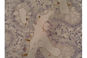 Immunohistochemistry staining of sialyl-Lewis a in colorectal adenocarcinoma (paraffin-embedded sections) with 121SLE antibody.