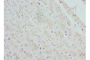 Immunohistochemistry of paraffin-embedded human colon cancer using ABIN7145457 at dilution of 1:100