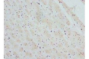 Immunohistochemistry of paraffin-embedded human colon cancer using ABIN7145457 at dilution of 1:100 (CTNNBL1 anticorps  (AA 264-563))