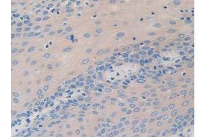 DAB staining on IHC-P; Samples: Human Stomach cancer Tissue (nectin-3 anticorps  (AA 171-377))