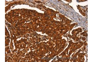 Immunohistochemistry of Human breast cancer using PRKD1 Polyclonal Antibody at dilution of 1:40 (PKC mu anticorps)