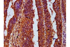 IHC image of ABIN7167644 diluted at 1:500 and staining in paraffin-embedded human colon cancer performed on a Leica BondTM system.