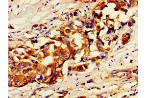 Immunohistochemistry of paraffin-embedded human breast cancer using ABIN7174356 at dilution of 1:100 (USP7 anticorps  (C-Term))