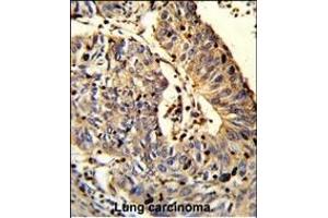 Formalin-fixed and paraffin-embedded human Lung carcinoma reacted with C21orf29 Antibody (Center), which was peroxidase-conjugated to the secondary antibody, followed by DAB staining. (TSPEAR anticorps  (AA 293-320))