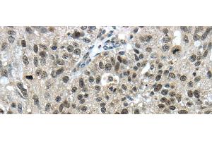 Immunohistochemistry of paraffin-embedded Human breast cancer using TRIM24 Polyclonal Antibody at dilution of 1/40 (TRIM24 anticorps)