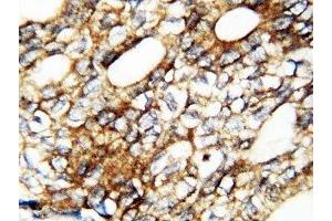 IHC-P: FGF1 antibody testing of human breast cancer tissue