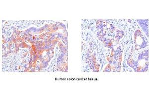 Paraffin embedded sections of human colon canitrocelluloseer tissue were initrocelluloseubated with anti-human Hsp27 (1:50) for 2 hours at room temperature.