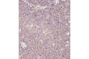 Immunohistochemical analysis of A on paraffin-embedded Human hepato carcinoma tissue. (PRKG1 anticorps  (C-Term))