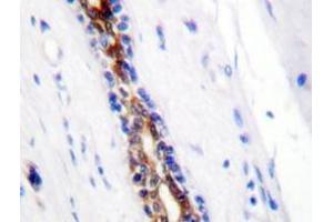 Immunohistochemistry analyzes of IRAK1 antibody in paraffin-embedded human breast carcinoma tissue. (IRAK1 anticorps)